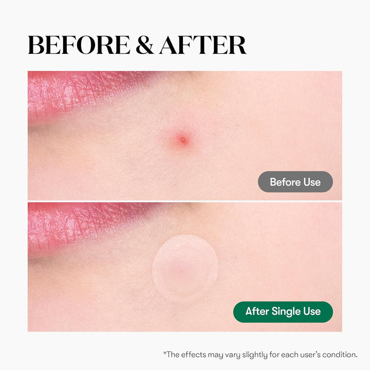VT Cosmetics – Cica Care Spot Patch - raminamieji pleistrai nuo spuogų